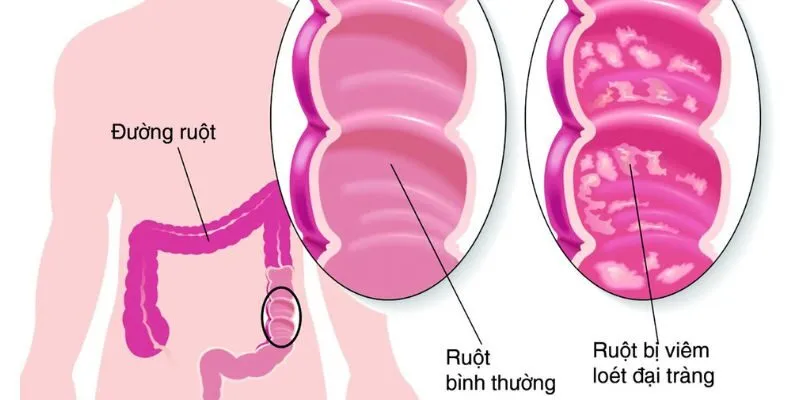 Bào Tử Lợi Khuẩn